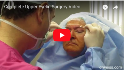 Complete Eyelid Surgery Image e1543360829288