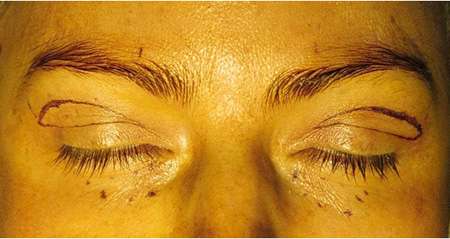 Female patient with marking on upper and lower eyelids to indicate where surgeries are to take place.