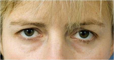 Female patient with upper eyelid droop and bags beneath her eyes.