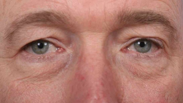 Male patient before upper and lower eyelid surgery