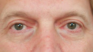 Male patient after upper and lower eyelid surgery
