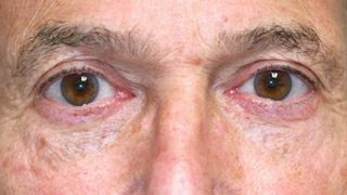 Male patient after eyelid surgery