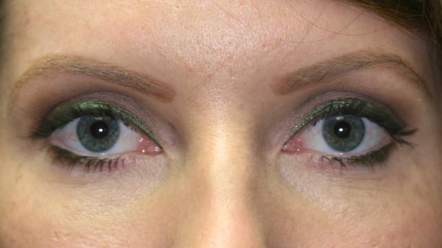 Female patient after upper eyelid surgery.