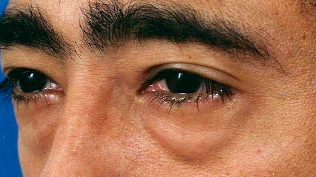 Male patient before lower eyelid surgery.