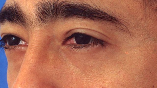 Male patient after lower eyelid surgery to remove fat from behind lower lids. This procedure was done with no skin incision.
