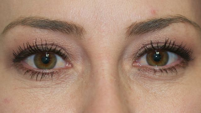 Female patient 52 has heavy full upper eyelids.