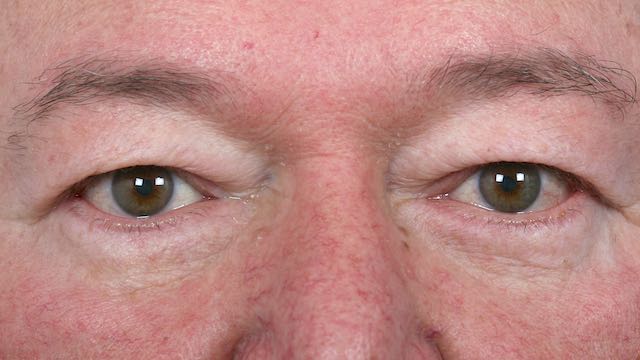Male patient #63 before upper and lower eyelid surgery.