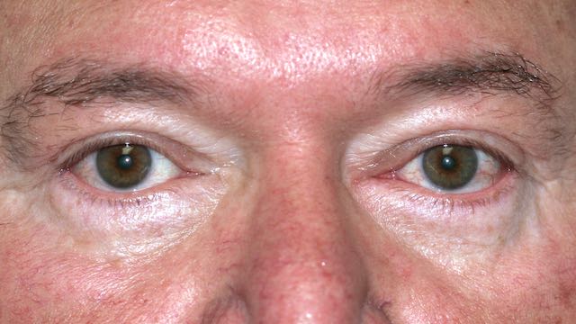 Male patient #63 after upper and lower eyelid surgery.