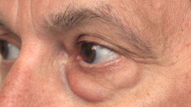 cosmetic eyelid surgery blepharoplasty75a